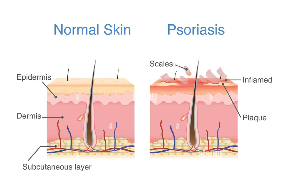 Image shows a diagram of normal skin compared to Psoriasis skin