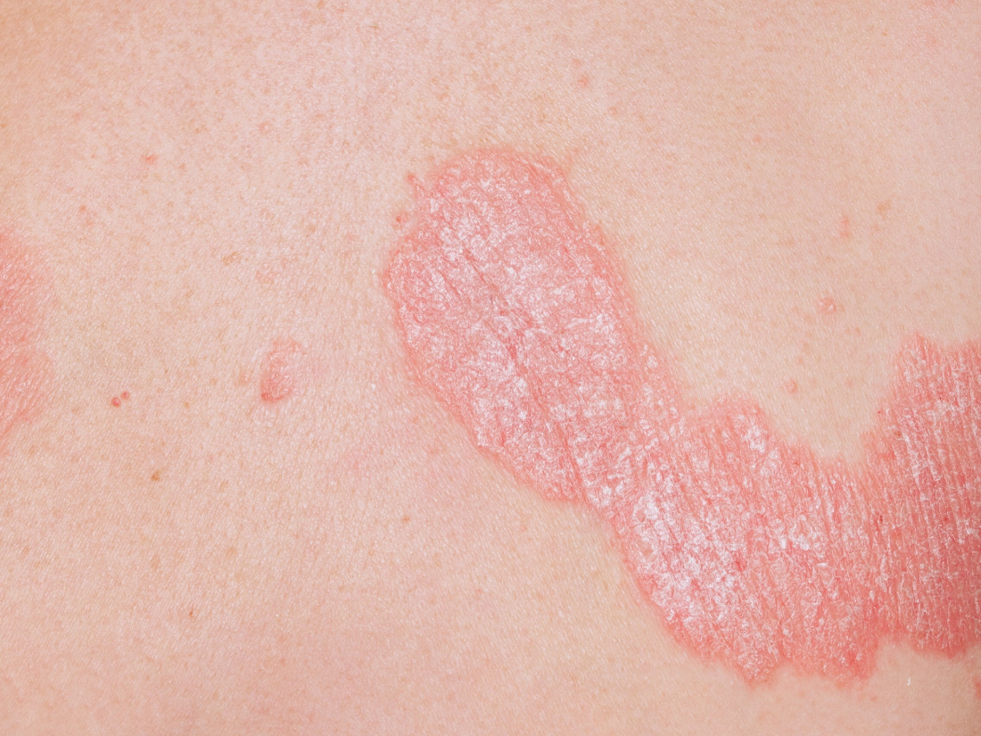 plaque-psoriasis-image-1